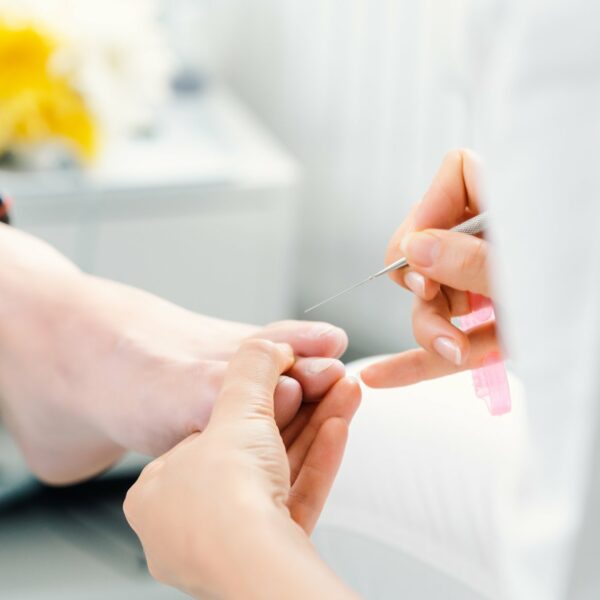 Precyzyjny zabieg pedicure narzędziem podologicznym na palcach stopy w PWKderma